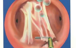 Фото: Классификация синехии полости матки