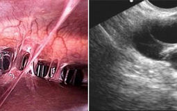 Фото: Синдром Ашермана