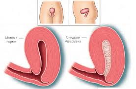 фото:Что такое им. бесплодие